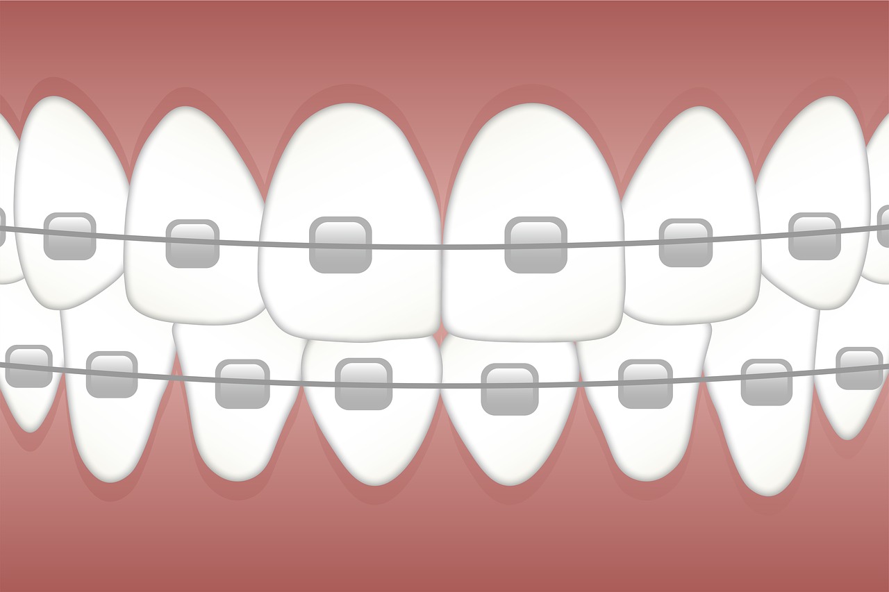 braces-3597591_1280